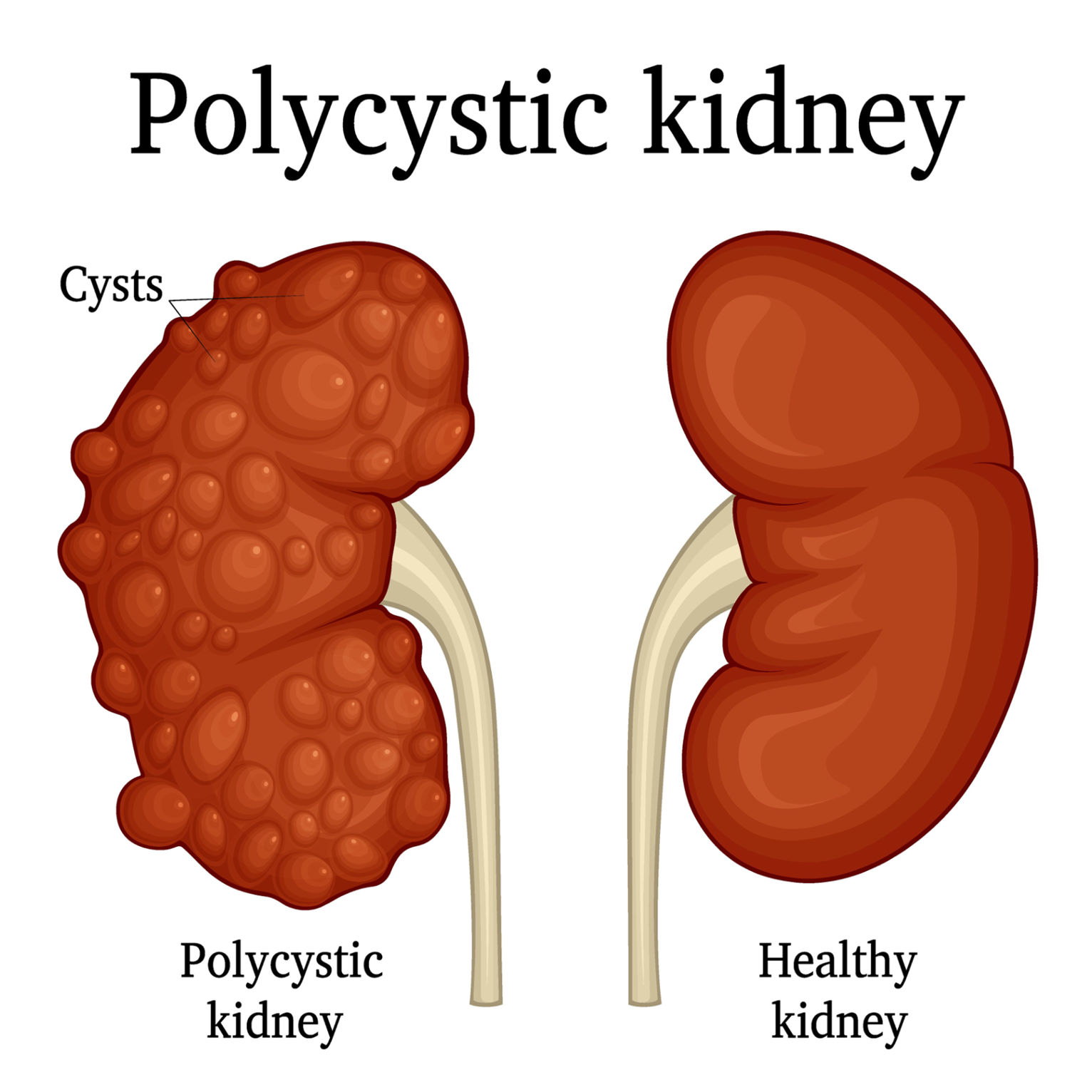 ARTICYST - Devising Open Science practices to promote research and treatment in cystic kidney disease project image